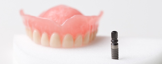 Zahnarzt Rheingoldcenter - Mit Hilfe der Implantologie können wir ganze Zähne inklusive Wurzel ersetzen.